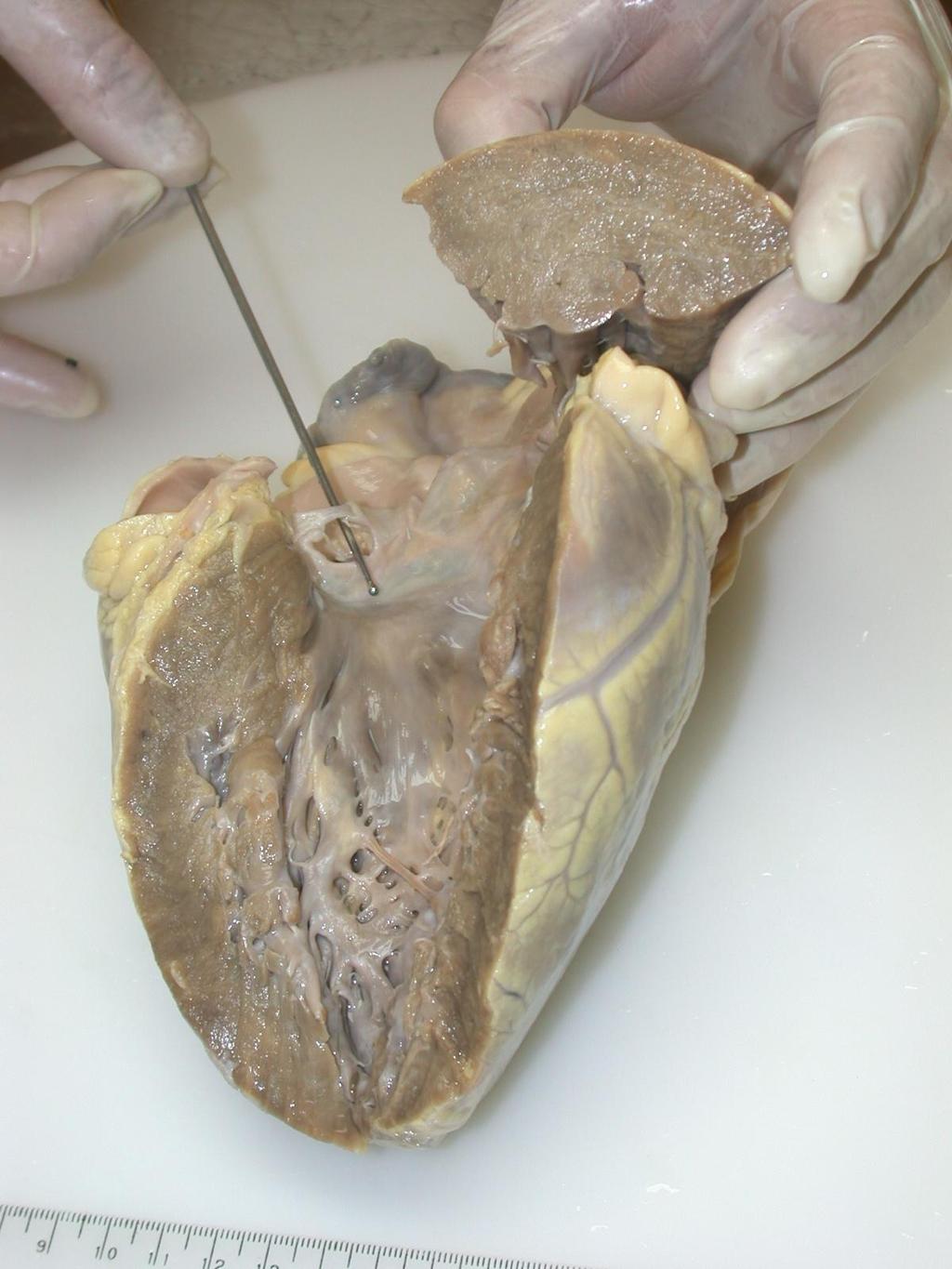 Az aorta billentyű vitiumainak ritka formája: valvula fenestrata.