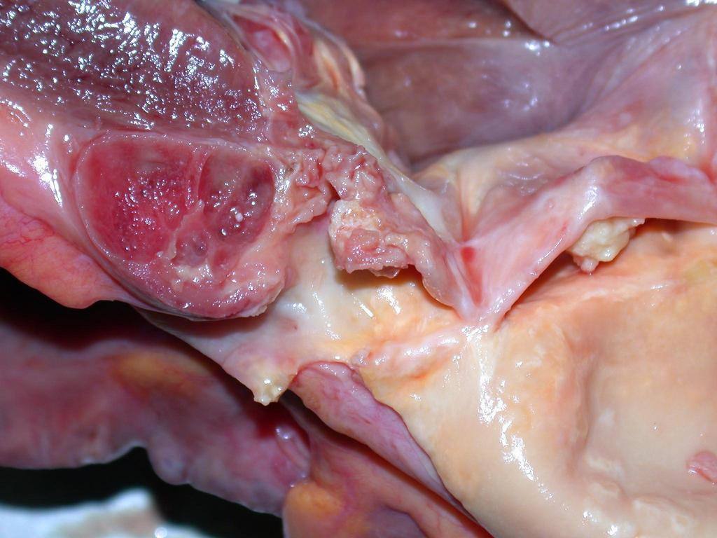 Az aorta billentyű roncsoló, fertőzéses subacut endocarditise paravalvularis, septatio jeleit is mutató, félheveny abscessussal.
