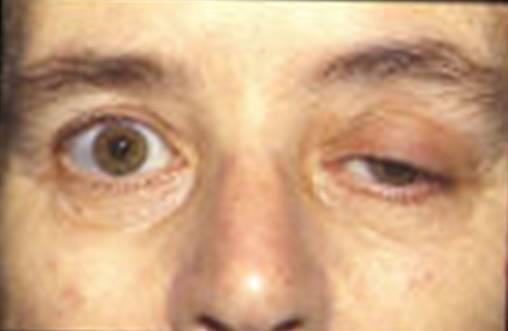 rezisztens gyermekkori epilepszia (Lennox-gastout és West sy) D: 300-400 mg/tskg heti 3x, majd 3 hetente ½ évig