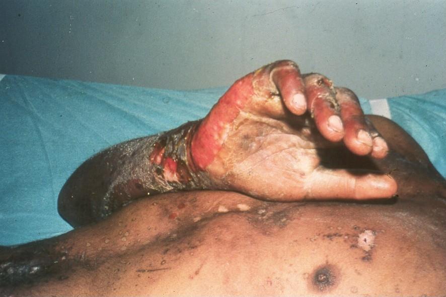 local radiation injuries (CRS cutaneous radiation syndrome).