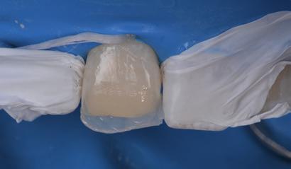 Felépítés dentin színnel (90% Opacitású A1 D) Dr.