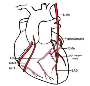 Eszközös keringéstámogatás, ECMO beültetés