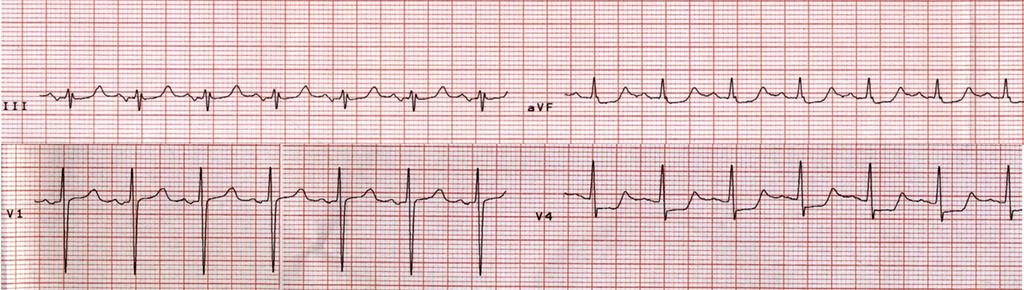 stent