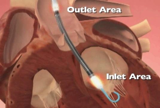 Impella 2.