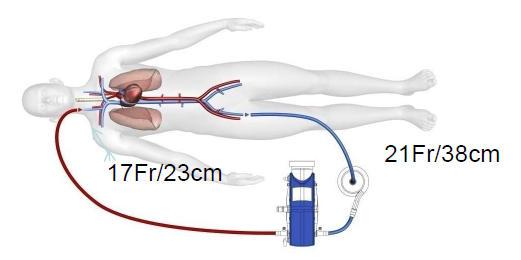 ExtraCorporeal Membrane