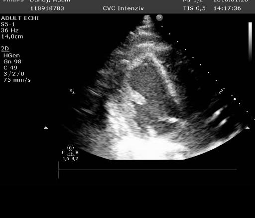 Echocardiographia TTE: norm.