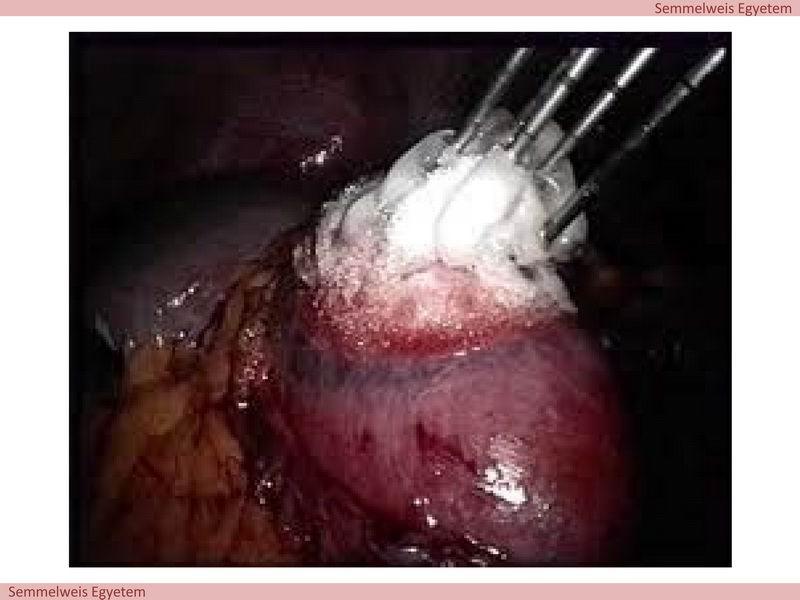 A.) A cryoablatiós típusok A cryoablatio hasonlóan az RFA-hoz jelenleg használható intraoperativan, laparascopos vagy percután technikaként. (1. ábra) 1.
