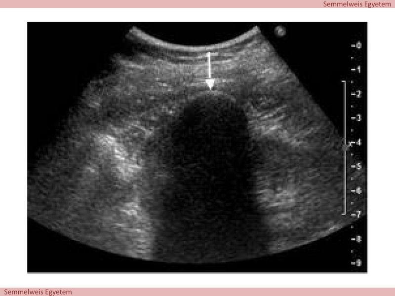 2. ábra: Vesetumor cryoablatiójának UH képe.