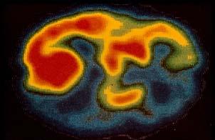 PET (Positron Emission Tomography) elv: det.