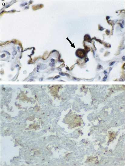 The histopathology of fatal untreated human respiratory syncytial virus infection Joyce EJohnson, Ricardo AGonzales, Sandy JOlson, Peter FWright and Barney SGraham Alveolar localization of RSV