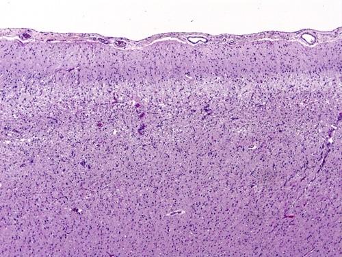 következménye Dementia Visualis