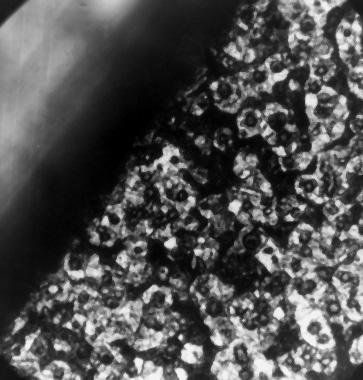 ) gömbgrafit jelenléte az öntvény belsejében az öntési olvadékban fellelhető felületi feszültség valamelyes csökkenésére utal a szabályos gömbgrafitnak megfelelő erőkkel szemben.