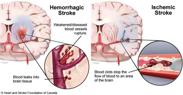 A stroke típusai Vérzéses stroke Agyi ér fala megpattan Érelzáródásos