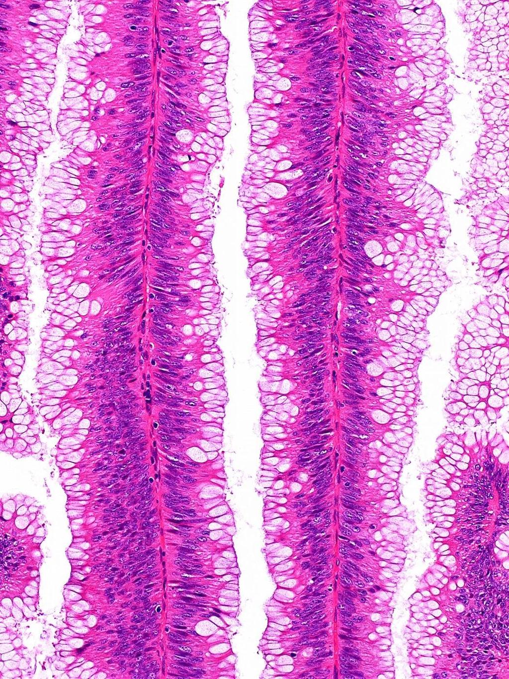 Adenoma villosum Többnyire a rectumban; magányos, nyél nélküli