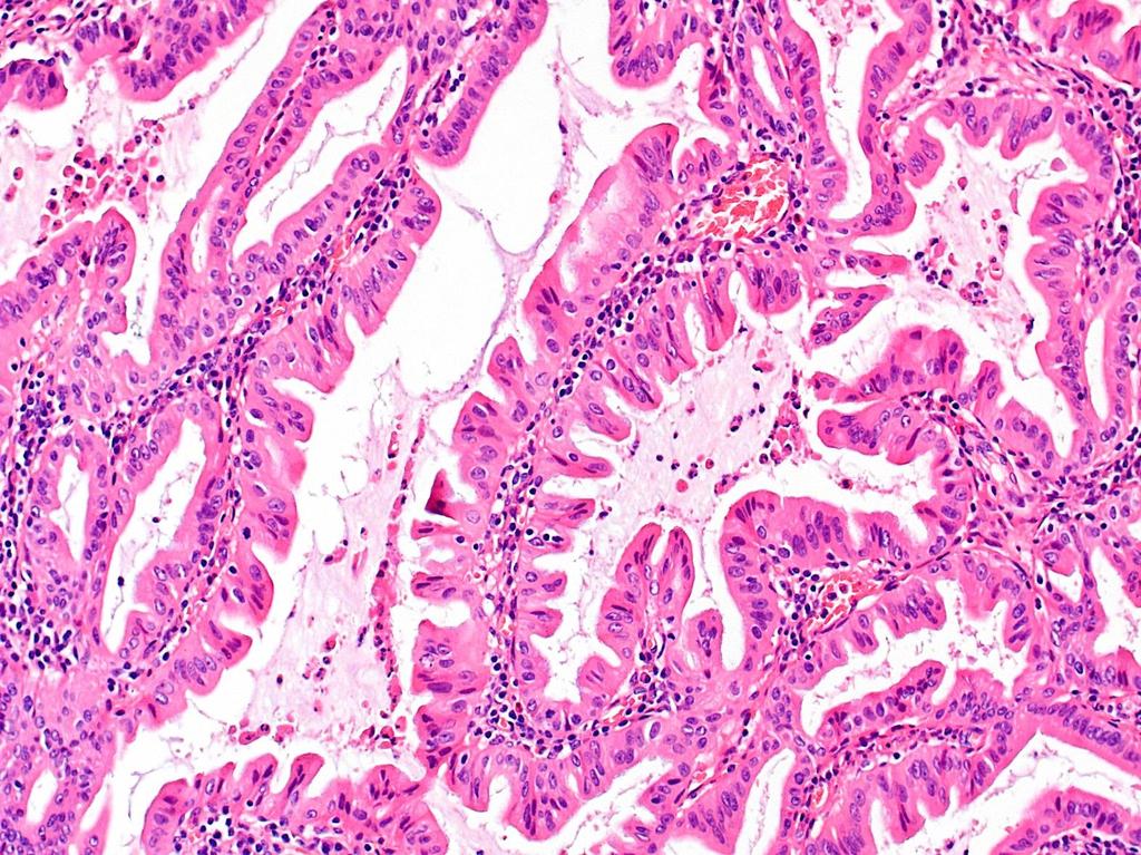 Sessilis fogazott adenoma A coecumban és a colon ascendens-ben gyakori; 5-15 mm közötti növedék FM: