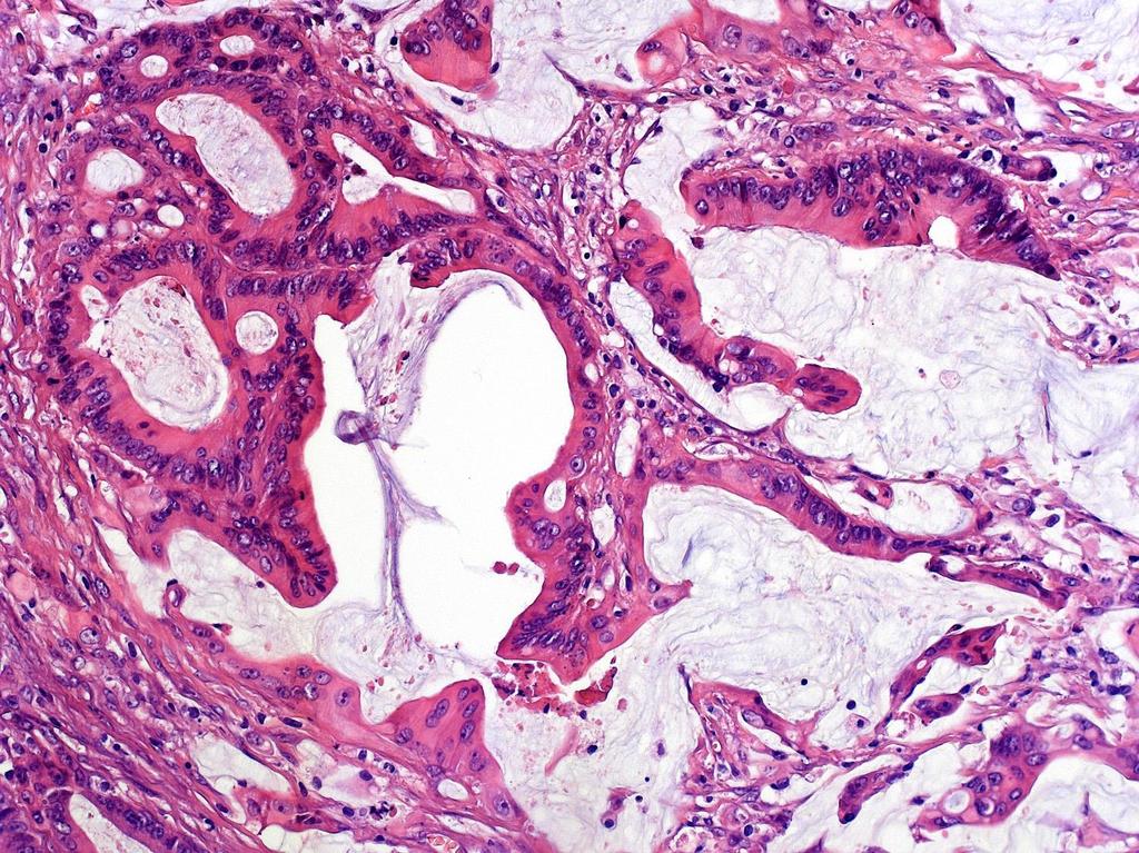 Mucinosus adenocarcinoma: a daganatsejtek által termelt nyák