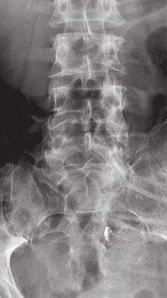 tárt fel. A harmadnap készült cervicalis, thoracalis és lumbalis gerinc-mr-vizsgálat további metasztázisokat írt le a mellkasi és lumbalis gerincen, valamint a sacrumban.