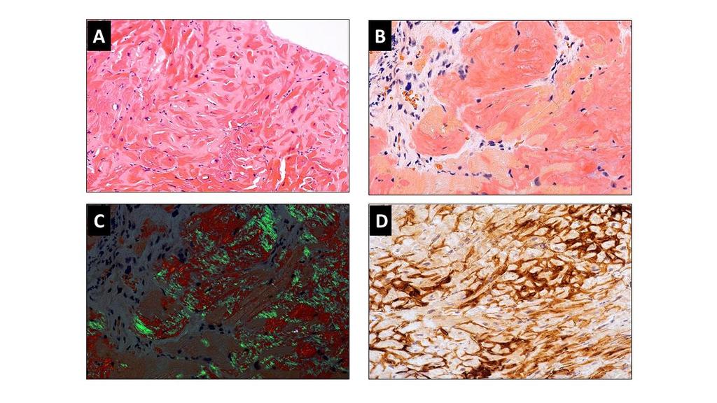 D panel: B beteg) nézetből. Hypertrophiás cardiomyopathia morfológiai képe, diffúz bal kamra hypertrophiával, papillaris izom és jobb kamra fal hypertrophiával, tág pitvarokkal. 5. ábra.
