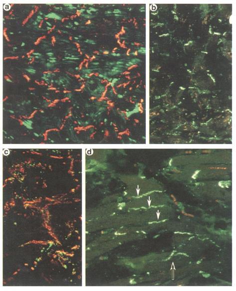 4.1.1.4. Az gap junction-ök eloszlása a myofiber disarray által érintett területeken A myofiber disarray által érintett szívizom területeken a gap junction-ök eloszlása szintén jelentős eltéréseket