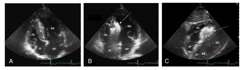 4.3. MEGFIGYELÉSEK PERKUTÁN TRANSZLUMINÁLIS SEPTALIS MYOCARDIUM ABLATIOVAL (PTSMA) KAPCSOLATBAN HYPERTROPHIÁS CARDIOMYOPATHIÁBAN 4.3.1.