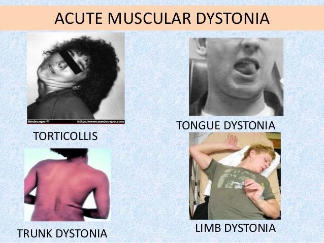 III. Sürgősségi pszichiátriai kórképek Gyógyszerszedéssel összefüggő állapotok Antipszichotikumok extrapiramidalis mellékhatásai dystonia, akathisia, parkinsonismus,