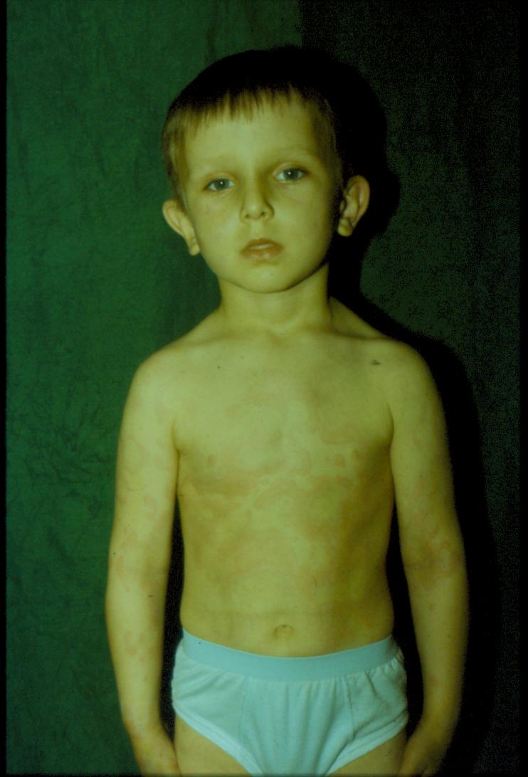 Urticaria