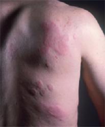 Urticaria