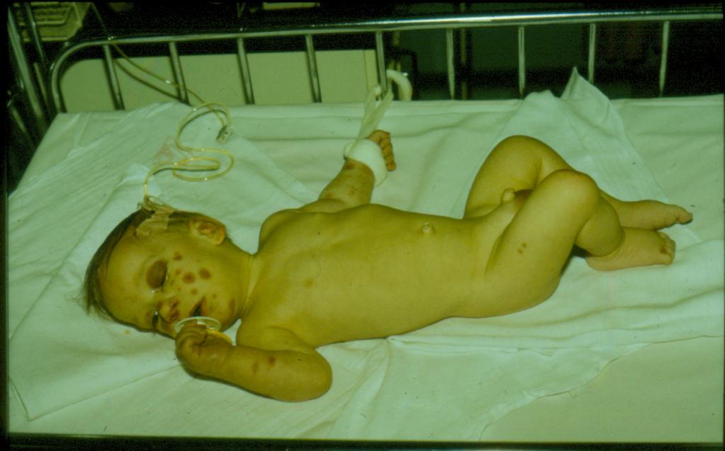 Erythema