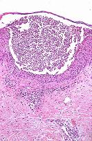 steril pustulák - Láz (>38 C) - Leukocytosis - Gyors kezdet