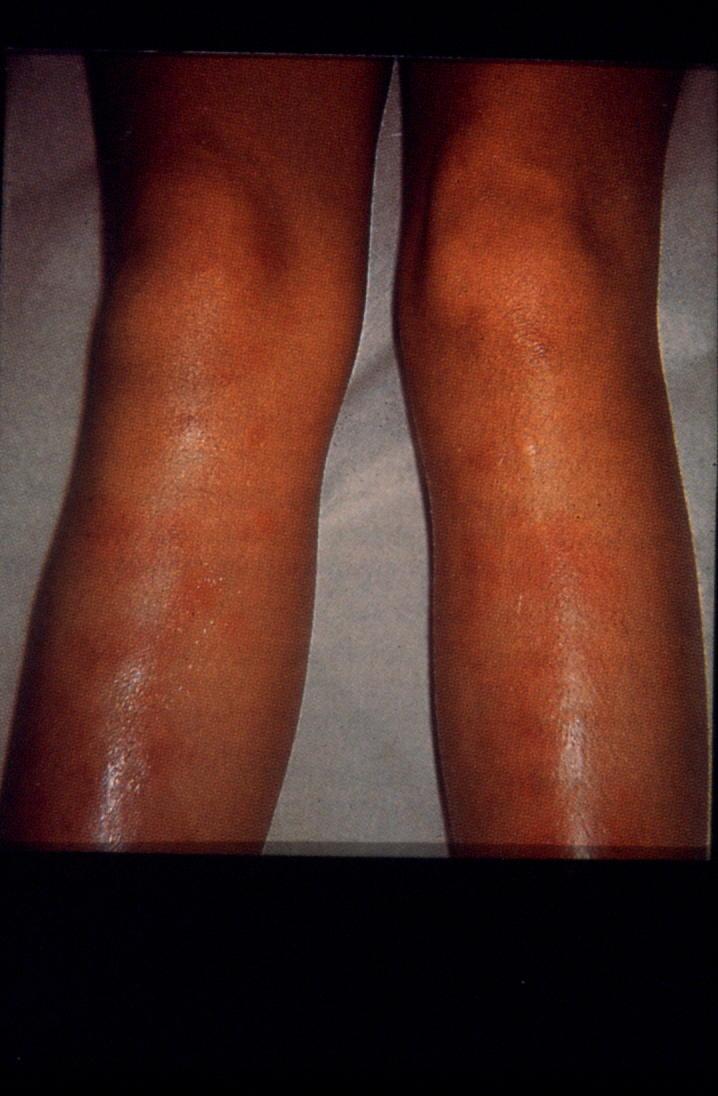 Erythema