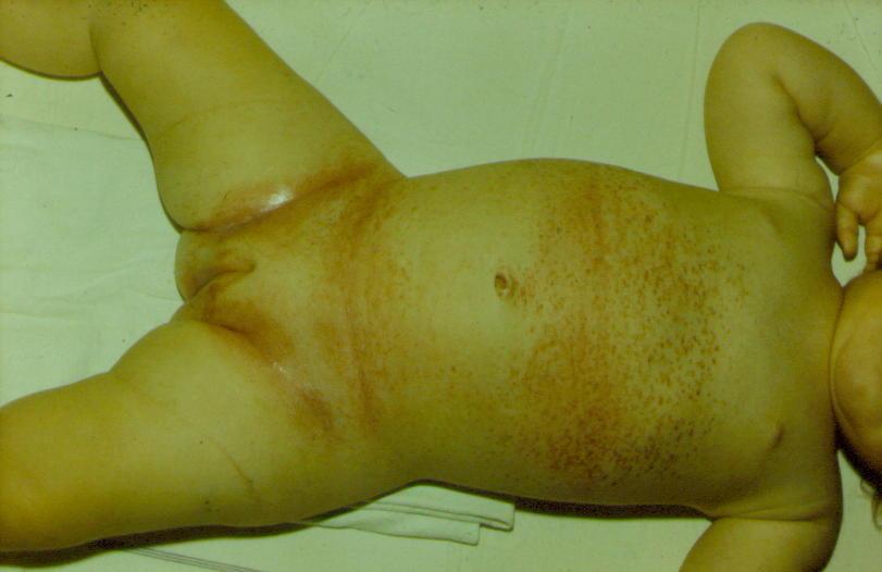 Histiocytosis X