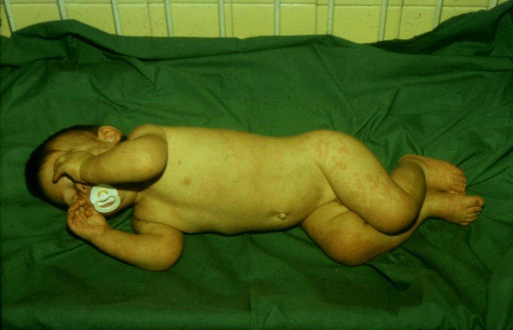 Urticaria