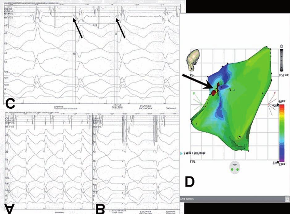 1. ábra A panel: Idiopathiás fascicularis VT EKG-képe. B panel: Identikus pace-map a sikeres ablatio helyén a bal kamrai midseptalis régióban.