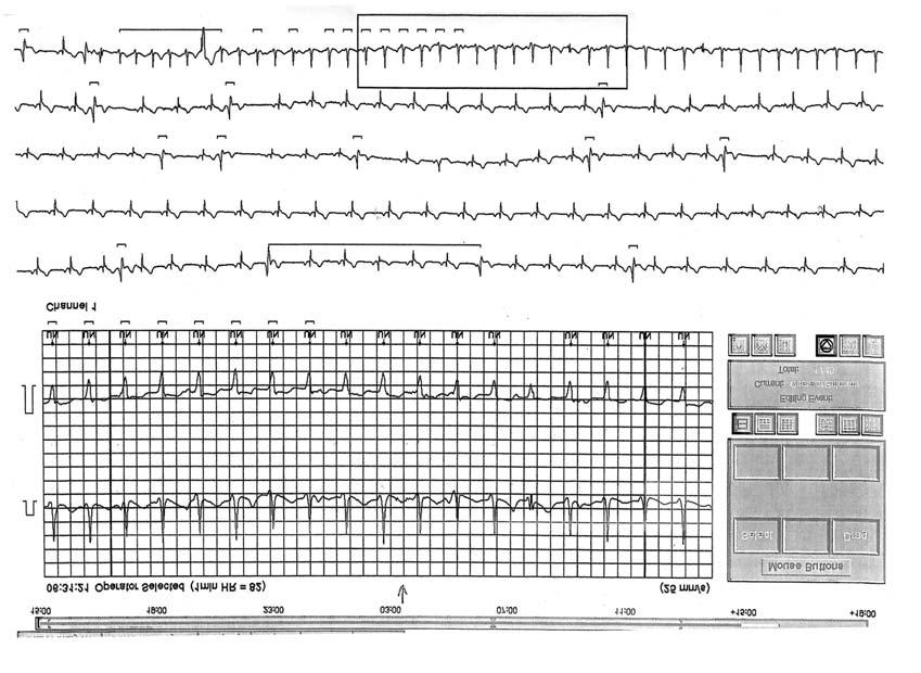 Az intracardialis regisztrálási technikák (pitvari, kamrai EKG-k, His-EKG, sinus coronarius EKG-k) különbözõ ingerlési technikák alkalmazásával együtt segítik a sinuscsomó betegség, az AV vezetési