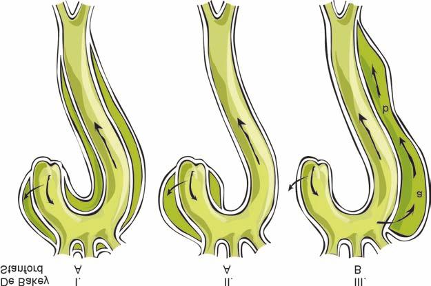 Aortadissectio Aortic dissection Mohácsi Attila Gottsegen György Országos Kardiológiai Intézet Kulcsszavak: aortadissectio Key-words: aortic dissection Az aortafal meggyengülését leggyakrabban