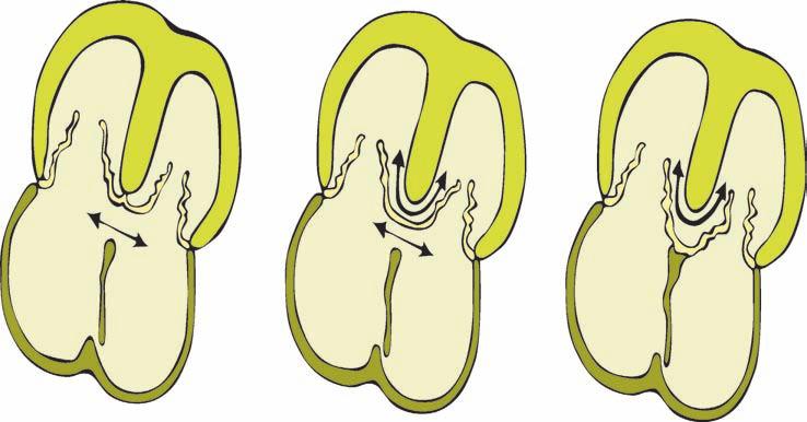 Veleszületett, bal-jobb shunttel járó szívbetegségek felnõttkorban Pitvari septumdefectusok, ductus Botalli persistens Adult congenital heart defects with left-to-right shunts - Atrial septal defects.