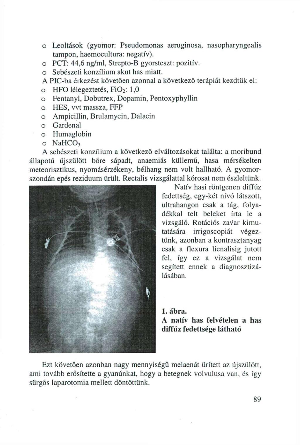 o Leoltások (gyomor: Pseudomonas aeruginosa, nasopharyngeal is tampon, haemocultura: negatív), o PCT: 44,6 ng/ml, Strepto-B gyorsteszt: pozitív, o Sebészeti konzílium akut has miatt.