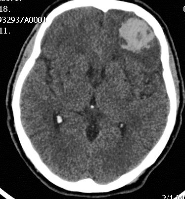 hypertensiv amyloid