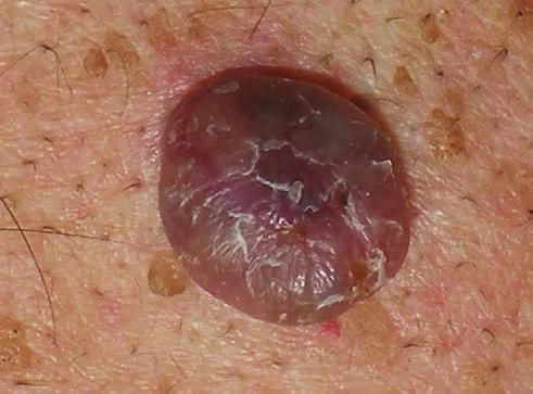 sejtes carcinoma, bőrfüggelék eredetű tumorok, Kaposi sarcoma és egyéb ritka sarcomák, valamint a bőr lymphomái adják (2).