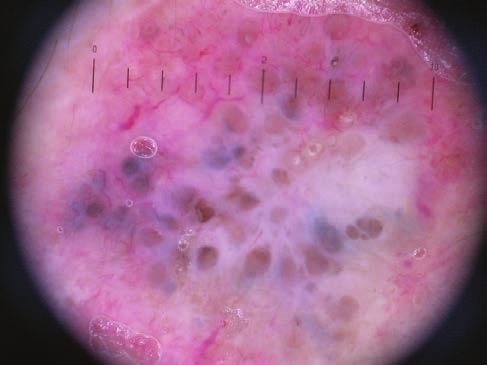 A B 7.c ábra Solaris keratosis dermatoszkópos képe 7.d ábra Laphámcarcinoma dermatoszkópos képe. Kifejezett vasculatura látható a tumorban.