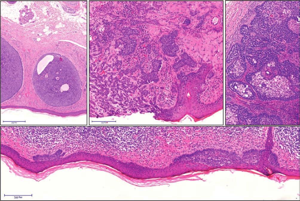 10.a ábra Non-melanoma