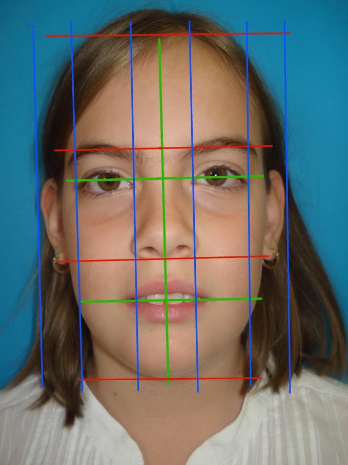 Facialis/makroesztétikai elemzés Arcarányok A három vertikális archarmad (hajvonalglabella, glabella-subnasale, subnasalementon) közül a felső és középső harmad arányos, míg az alsó harmad eltér,