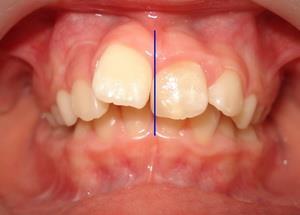 Dentolabialis/miniesztétikai elemzés Szimmetriaviszonyok Lágyrész(philtrum) középvonalhoz és