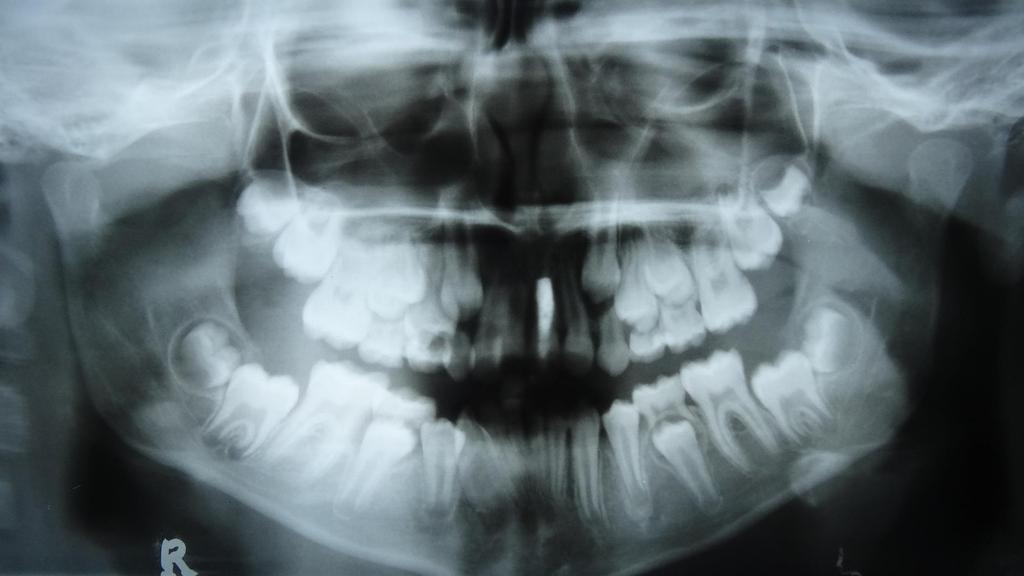 Röntgenelemzés Orthopantomogram (OP) Fogváltás folyamatban. Csírahiány, számfeletti fog, rendellenes csírahelyzet nem látható. 21 fog gyökértömött (máshol kezelik).