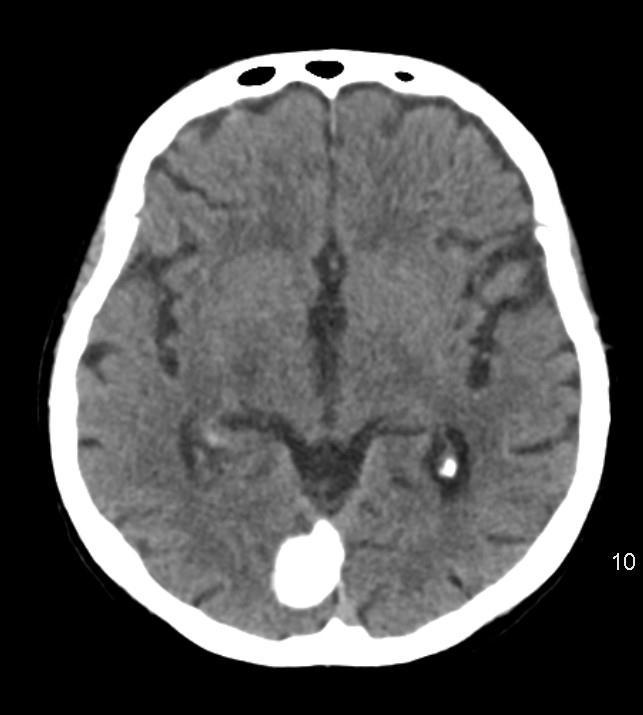 1. kép. CT axiális felvétel, kontrasztanyaggal. Occipitalis falx meningeoma. 2.4.2 MR képalkotás: Az MR gépekkel készült koponya felvételek nagyon jó diagnosztikus értékekkel bírnak.