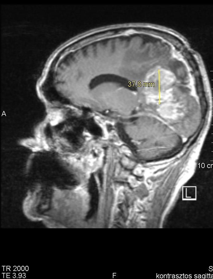 4.kép. MR T1 kontrasztanyagos sagittális kép. Jól látható a recidív tumor. Ebből adódóan az is látható, hogy bár a műtét sikeres volt, a tumor újból kialakult.