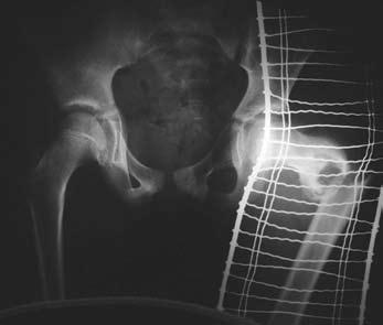 1. a b ábra Juvenilis ciszta talaján kialakult subtrochanter