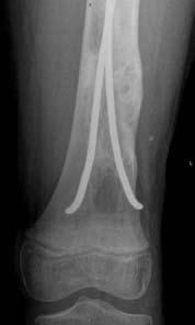 Az osteoconductio során a szintetikus anyag vázat képez a környező új csont (osteoblastok illetve osteoprogenitor sejtek, új erek) számára az átépülés idejére, majd optimális esetben teljesen