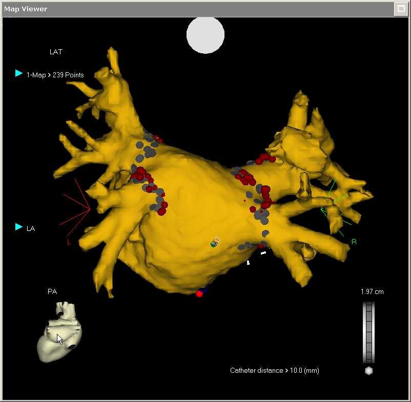 ablation Catheter