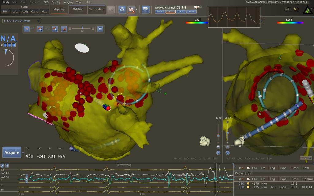 CARTO 3 antral